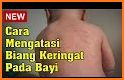 tips sehat dan mudah mengatasi masalah kulit bayi related image