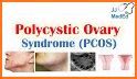 PCOS (Polycystic Ovary Synd.) related image