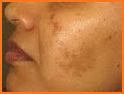 Face Blemishes Removal related image