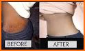 Get Rid of Body Stretch Marks related image