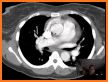 Chest CT Sectional Walker related image