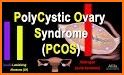 PCOS (Polycystic Ovary Synd.) related image