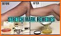 Get Rid of Body Stretch Marks related image