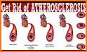 Atherosclerosis Home Remedies related image