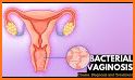 Bacteria Vaginosis related image