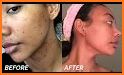 Face Blemishes Removal related image