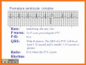 ACLS Rhythm Tutor related image