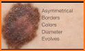 Check Melanoma related image