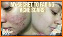 Acne Scar Removal Tips and Tricks related image