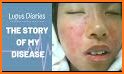 Lupus Diary related image