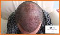 Hair Transplantation Istanbul / How Much Grafts? related image