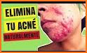 como curar el acne related image