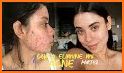 como curar el acne related image