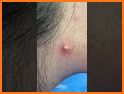 Pimple Pop Squeeze related image