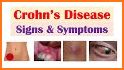 Crohns Diary related image