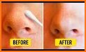 Get Rid Of Blackheads Naturally - 12 Home Remedies related image