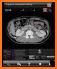 Chest CT Sectional Walker related image