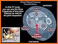 AO/OTA Fracture Classification related image