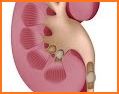 STONE Nephrolithometry - Kidney Stone in Urology related image