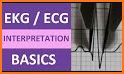 ECG Interpretation MIE related image