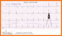 ECG Basics - Learning and interpretation made easy related image