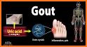 A gout related image