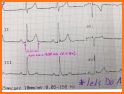 Electrocardiogram (ECG) Rhythm App: Corrected QT related image