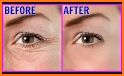 Under Eye Wrinkles Home Remedies related image