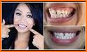 Braces teeth Photo Editor & Selfie Camera related image