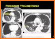 CXR FlashCards related image