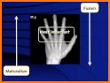 Bone Age Calculator related image