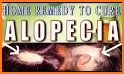 Alopecia Treatment- Home Remedies For Hair Growth related image