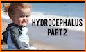 Hydrocephalus 2019 related image