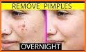 Acne Treatment Remedies For Pimples, Skin & Face related image