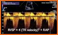 LEARN THE FULL TTE ECHO ULTRASOUND PROTOCOL related image