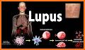 Lupus (SLE) related image