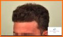 Hair Transplantation Istanbul / How Much Grafts? related image