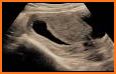 Momitalk: Pregnancy Ultrasound related image