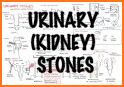 STONE Nephrolithometry - Kidney Stone in Urology related image