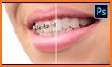 Braces Photo Editor related image