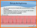 ECG FlashCards - Free related image