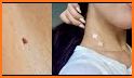 Skin tags Treatment and Home Remedies To Remove related image