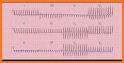 A to Z ECG Interpretation related image