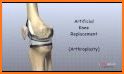 Nail & Foot doctor - Knee replacement surgery related image