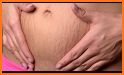 Get rid of STRETCH MARKS - Home Remedies related image