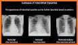 Chest X-Ray Interpretation related image