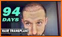 Hair Transplantation Istanbul / How Much Grafts? related image