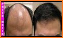 Treatment of hair loss related image