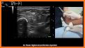 MSK ultrasound Upper Limb related image