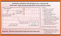 EKG DDX related image